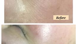 Facial results, before and after
