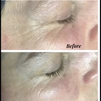 Facial results, before and after